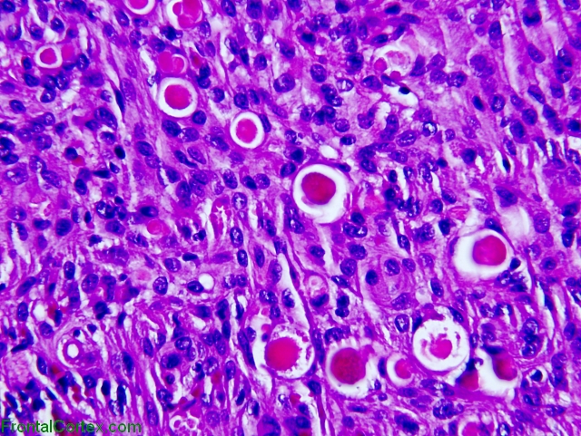 Secretory meningioma, H&E stain x400